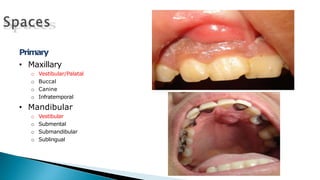 Primary
• Maxillary
o Vestibular/Palatal
o Buccal
o Canine
o Infratemporal
• Mandibular
o Vestibular
o Submental
o Submandibular
o Sublingual
 