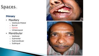 Primary
• Maxillary
o Vestibular/Palatal
o Buccal
o Canine
o Infratemporal
• Mandibular
o Vestibular
o Submental
o Submandibular
o Sublingual
 