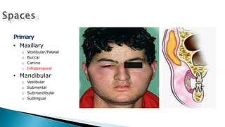 Primary
• Maxillary
o Vestibular/Palatal
o Buccal
o Canine
o Infratemporal
• Mandibular
o Vestibular
o Submental
o Submandibular
o Sublingual
 