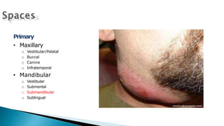 Primary
• Maxillary
o Vestibular/Palatal
o Buccal
o Canine
o Infratemporal
• Mandibular
o Vestibular
o Submental
o Submandibular
o Sublingual
 