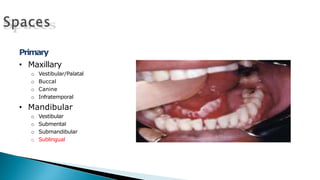 Primary
• Maxillary
o Vestibular/Palatal
o Buccal
o Canine
o Infratemporal
• Mandibular
o Vestibular
o Submental
o Submandibular
o Sublingual
 
