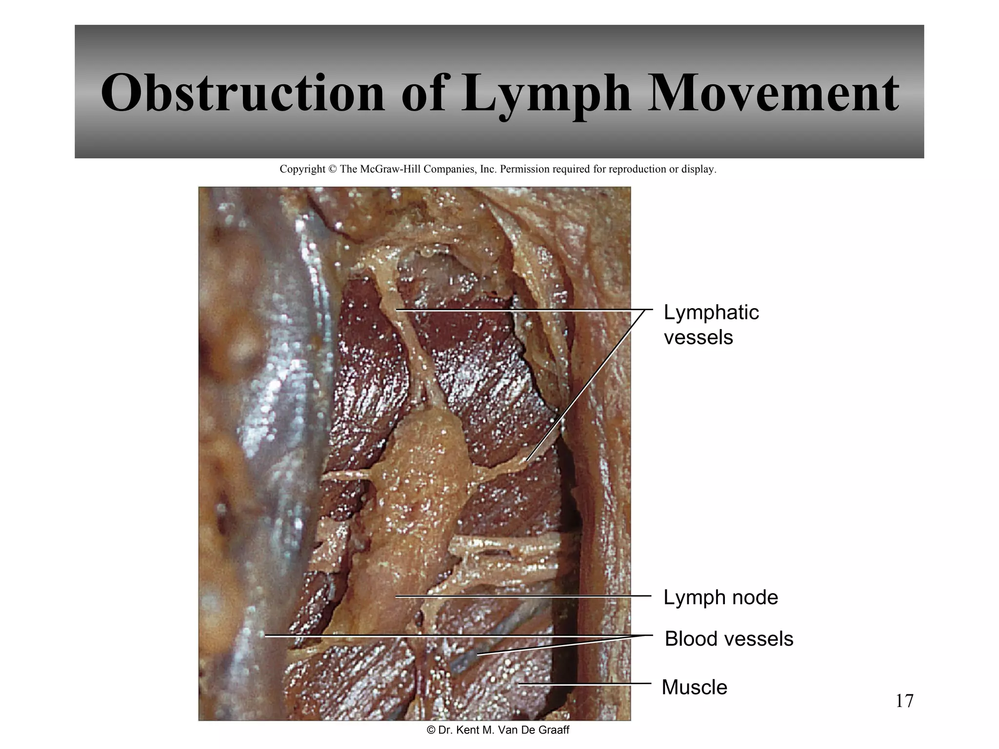 Obstruction of Lymph Movement Copyright © The McGraw-Hill Companies, Inc. Permission required for reproduction or display. Blood vessels Lymph node Muscle Lymphatic vessels © Dr. Kent M. Van De Graaff 