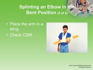 Chapter 16 Splinting Extremeties | PPTX