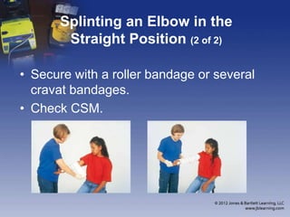 Chapter 16 Splinting Extremeties | PPTX