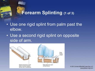 Forearm Rotation Splinting Chapter 16 Splinting Extremeties | PPTX