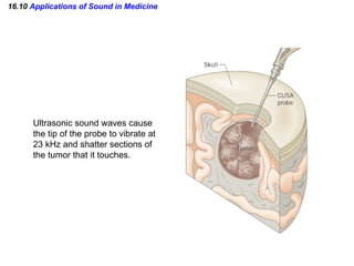 16.10  Applications of Sound in Medicine Ultrasonic sound waves cause the tip of the probe to vibrate at 23 kHz and shatter sections of the tumor that it touches. 