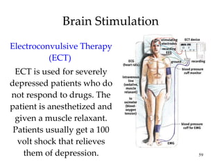 Brain Stimulation Electroconvulsive Therapy (ECT)  ECT is used for severely depressed patients who do not respond to drugs. The patient is anesthetized and given a muscle relaxant. Patients usually get a 100 volt shock that relieves them of depression. 