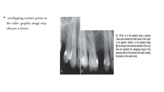 Typical Radiographic Appearance
 