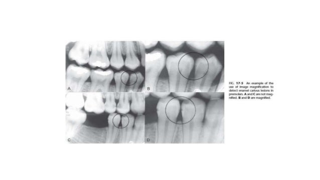Mach Band Effect In Dentistry