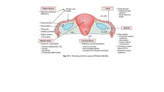 Infertility Overview Comprehensive Overview of Infertility: Causes, Diagnosis, and ...