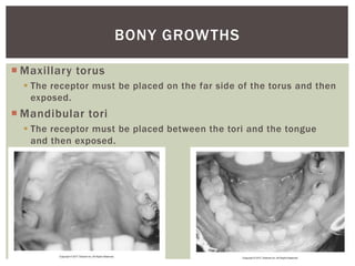  Maxillary torus
 The receptor must be placed on the far side of the torus and then
exposed.
 Mandibular tori
 The receptor must be placed between the tori and the tongue
and then exposed.
28
BONY GROWTHS
 