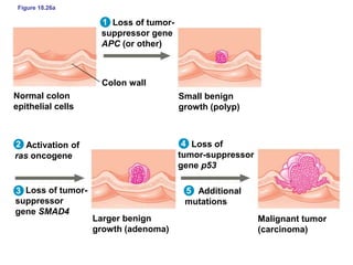 Figure 18.26a
1
Colon wall
Loss of tumor-
suppressor gene
APC (or other)
Normal colon
epithelial cells
2
3
4
5
Activation of
ras oncogene
Additional
mutations
Loss of tumor-
suppressor
gene SMAD4
Larger benign
growth (adenoma)
Malignant tumor
(carcinoma)
Small benign
growth (polyp)
Loss of
tumor-suppressor
gene p53
 