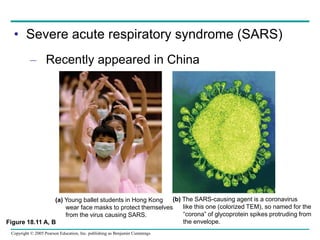 Copyright © 2005 Pearson Education, Inc. publishing as Benjamin Cummings
• Severe acute respiratory syndrome (SARS)
– Recently appeared in China
Figure 18.11 A, B
(a) Young ballet students in Hong Kong
wear face masks to protect themselves
from the virus causing SARS.
(b) The SARS-causing agent is a coronavirus
like this one (colorized TEM), so named for the
“corona” of glycoprotein spikes protruding from
the envelope.
 