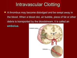 Intravascular ClottingIntravascular Clotting
 A thrombus may become dislodged and be swept away inA thrombus may become dislodged and be swept away in
the blood. When a blood clot, air bubble, piece of fat or otherthe blood. When a blood clot, air bubble, piece of fat or other
debris is transported by the bloodstream, it is called andebris is transported by the bloodstream, it is called an
embolus.embolus.
 