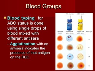 Blood GroupsBlood Groups
 Blood typingBlood typing forfor
ABO status is doneABO status is done
using single drops ofusing single drops of
blood mixed withblood mixed with
different antiseradifferent antisera
– AgglutinationAgglutination with anwith an
antisera indicates theantisera indicates the
presence of that antigenpresence of that antigen
on the RBCon the RBC
 