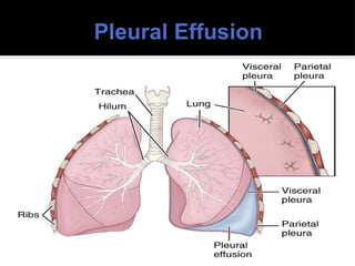 Pleural Effusion
 