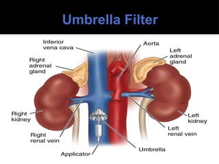 Umbrella Filter
 