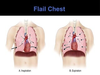Flail Chest
 