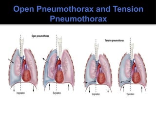 Open Pneumothorax and Tension
Pneumothorax
 