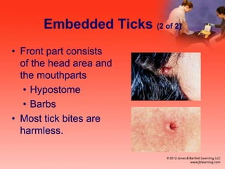 Embedded Ticks (2 of 2)
• Front part consists
of the head area and
the mouthparts
• Hypostome
• Barbs
• Most tick bites are
harmless.
 