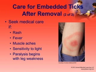 Care for Embedded Ticks
After Removal (2 of 2)
• Seek medical care
if:
• Rash
• Fever
• Muscle aches
• Sensitivity to light
• Paralysis begins
with leg weakness
Courtesy of James Gathany/CDC
 