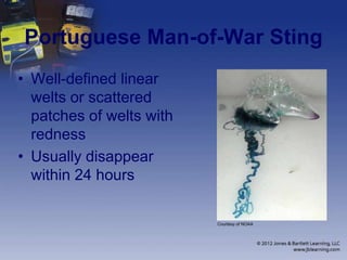 Portuguese Man-of-War Sting
• Well-defined linear
welts or scattered
patches of welts with
redness
• Usually disappear
within 24 hours
Courtesy of NOAA
 