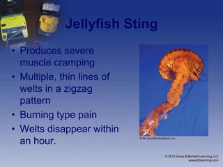 Jellyfish Sting
• Produces severe
muscle cramping
• Multiple, thin lines of
welts in a zigzag
pattern
• Burning type pain
• Welts disappear within
an hour. © Nir Levy/ShutterStock, Inc.
 