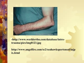 -http://www.worldortho.com/database/intro-
trauma/pics/img0123.jpg
http://www.angelfire.com/sc2/seahawksportsmed/injp
ix.html
 