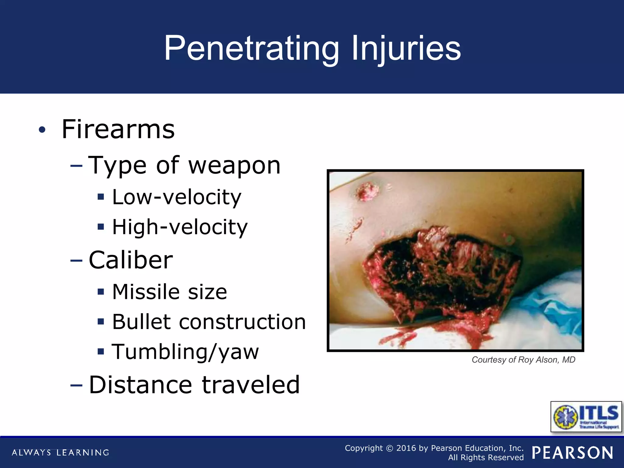 Copyright © 2016 by Pearson Education, Inc.
All Rights Reserved
Penetrating Injuries
• Firearms
– Type of weapon
 Low-velocity
 High-velocity
– Caliber
 Missile size
 Bullet construction
 Tumbling/yaw
– Distance traveled
Courtesy of Roy Alson, MD
 