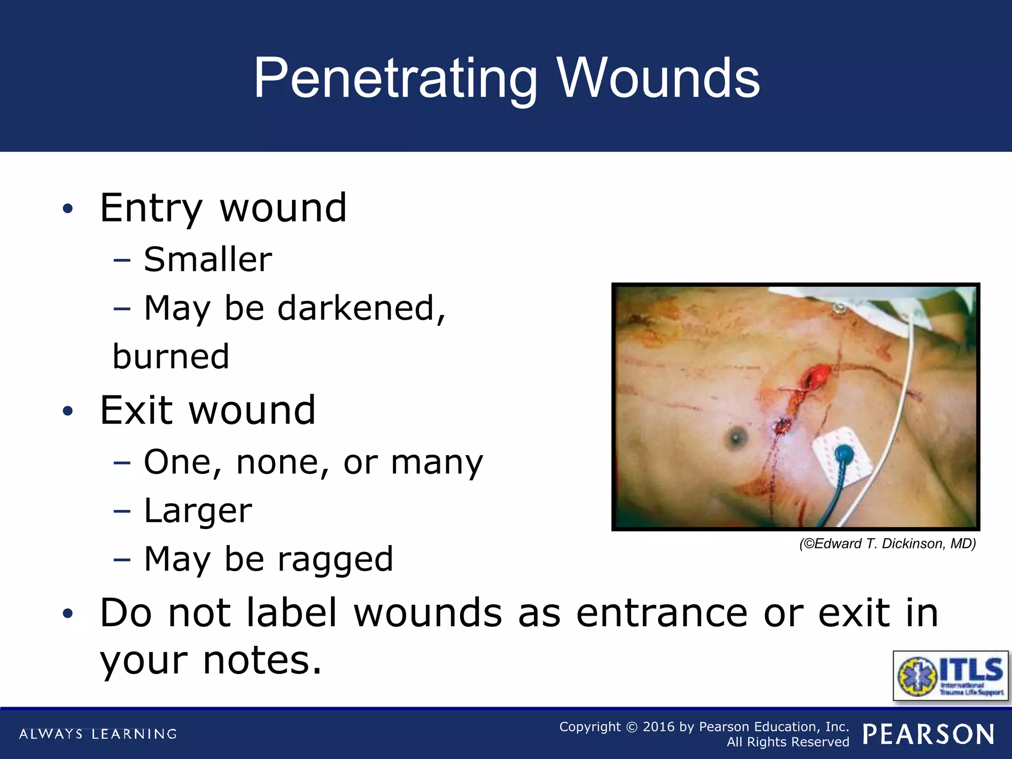 Copyright © 2016 by Pearson Education, Inc.
All Rights Reserved
Penetrating Wounds
• Entry wound
– Smaller
– May be darkened,
burned
• Exit wound
– One, none, or many
– Larger
– May be ragged
• Do not label wounds as entrance or exit in
your notes.
(©Edward T. Dickinson, MD)
 