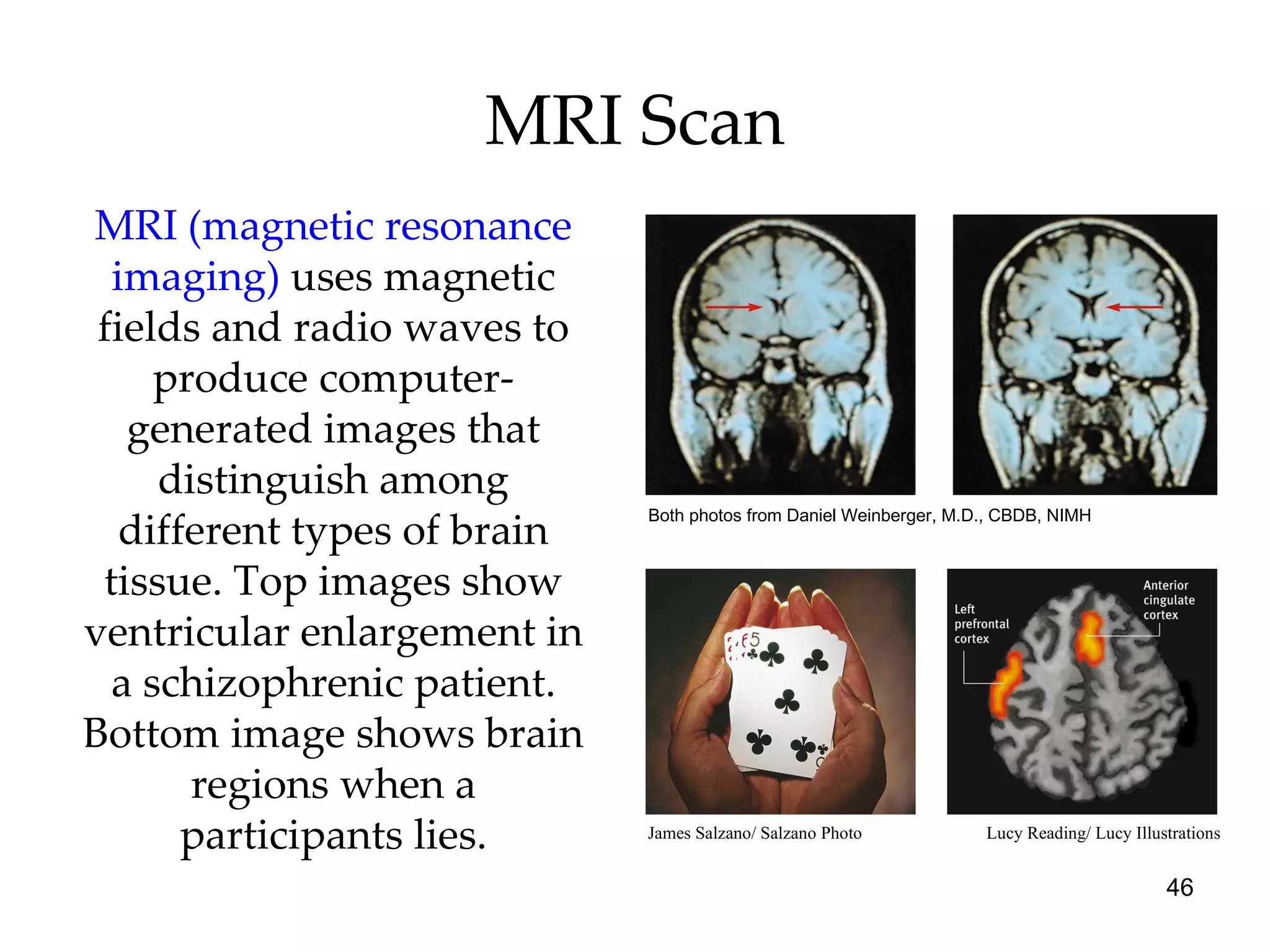 MRI Scan MRI (magnetic resonance imaging)  uses magnetic fields and radio waves to produce computer-generated images that distinguish among different types of brain tissue. Top images show ventricular enlargement in a schizophrenic patient. Bottom image shows brain regions when a participants lies. Both photos from Daniel Weinberger, M.D., CBDB, NIMH James Salzano/ Salzano Photo Lucy Reading/ Lucy Illustrations 