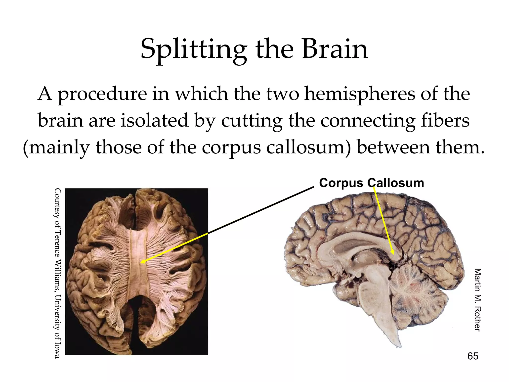 Splitting the Brain A procedure in which the two hemispheres of the brain are isolated by cutting the connecting fibers (mainly those of the corpus callosum) between them. Corpus Callosum Martin M. Rother Courtesy of Terence Williams, University of Iowa 