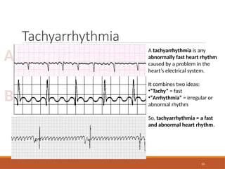 10
Tachyarrhythmia
A
B
A tachyarrhythmia is any
abnormally fast heart rhythm
caused by a problem in the
heart’s electrical system.
It combines two ideas:
•“Tachy” = fast
•“Arrhythmia” = irregular or
abnormal rhythm
So, tachyarrhythmia = a fast
and abnormal heart rhythm.
 