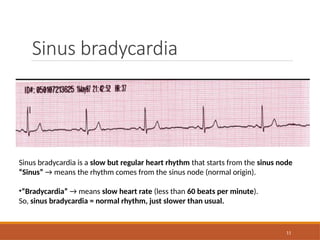 11
Sinus bradycardia
Sinus bradycardia is a slow but regular heart rhythm that starts from the sinus node
“Sinus” → means the rhythm comes from the sinus node (normal origin).
•“Bradycardia” → means slow heart rate (less than 60 beats per minute).
So, sinus bradycardia = normal rhythm, just slower than usual.
 