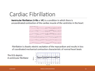 Cardiac Fibrillation
02/03/2026 MEDICAL INSTRUMENTATION 14
 
