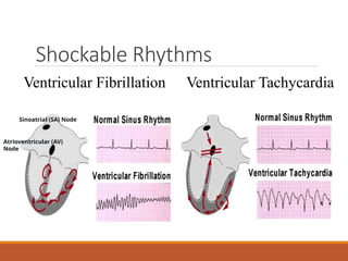 Shockable Rhythms
Ventricular Fibrillation Ventricular Tachycardia
Sinoatrial (SA) Node
Atrioventricular (AV)
Node
 