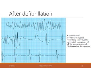 After defibrillation
02/03/2026 MEDICAL INSTRUMENTATION 68
 