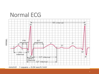 7
Normal ECG
 