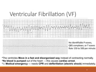8
Ventricular Fibrillation (VF)
•The ventricles Move in a fast and disorganized way instead of contracting normally.
•No blood is pumped out of the heart → this causes cardiac arrest.
•⚠️Medical emergency — needs CPR and defibrillation (electric shock) immediately.
No identifiable P waves,
QRS complexes, or T waves
Rate 150 to 500 per minute
 