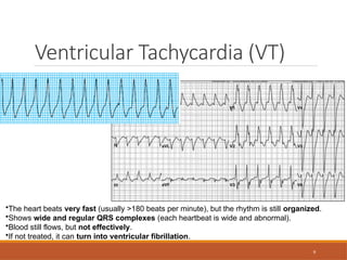 9
Ventricular Tachycardia (VT)
•The heart beats very fast (usually >180 beats per minute), but the rhythm is still organized.
•Shows wide and regular QRS complexes (each heartbeat is wide and abnormal).
•Blood still flows, but not effectively.
•If not treated, it can turn into ventricular fibrillation.
 