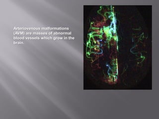 Arteriovenous malformations
(AVM) are masses of abnormal
blood vessels which grow in the
brain.
 