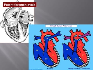Patent foramen ovale
 