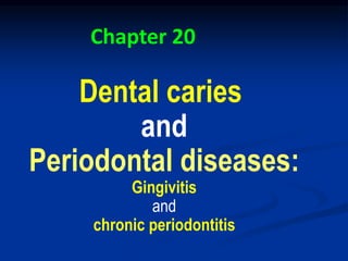 Dental caries
and
Periodontal diseases:
Gingivitis
and
chronic periodontitis
Chapter 20
 
