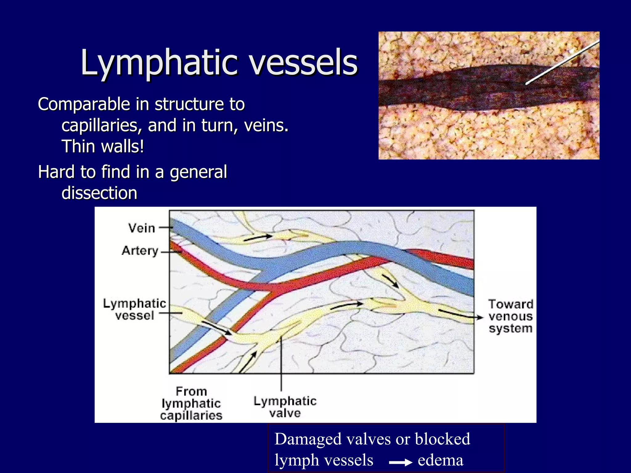 Lymphatic vessels Comparable in structure to capillaries, and in turn, veins.  Thin walls! Hard to find in a general dissection Damaged valves or blocked lymph vessels  edema 