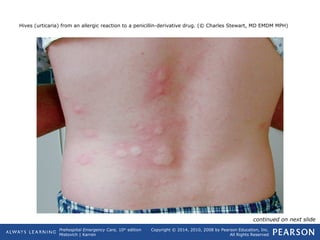 Prehospital Emergency Care, 10th
edition
Mistovich | Karren
Copyright © 2014, 2010, 2008 by Pearson Education, Inc.
All Rights Reserved
Hives (urticaria) from an allergic reaction to a penicillin-derivative drug. (© Charles Stewart, MD EMDM MPH)
continued on next slide
 
