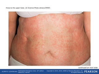 Prehospital Emergency Care, 10th
edition
Mistovich | Karren
Copyright © 2014, 2010, 2008 by Pearson Education, Inc.
All Rights Reserved
Hives to the upper body. (© Science Photo Library/CMSP)
continued on next slide
 