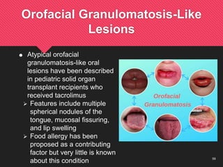 59
Orofacial Granulomatosis-Like
Lesions
 Atypical orofacial
granulomatosis-like oral
lesions have been described
in pediatric solid organ
transplant recipients who
received tacrolimus
 Features include multiple
spherical nodules of the
tongue, mucosal fissuring,
and lip swelling
 Food allergy has been
proposed as a contributing
factor but very little is known
about this condition
 