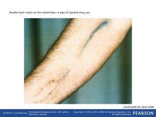 Prehospital Emergency Care, 10th
edition
Mistovich | Karren
Copyright © 2014, 2010, 2008 by Pearson Education, Inc.
All Rights Reserved
Needle track marks on the extremities—a sign of injected drug use.
continued on next slide
 