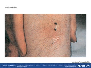 Prehospital Emergency Care, 10th
edition
Mistovich | Karren
Copyright © 2014, 2010, 2008 by Pearson Education, Inc.
All Rights Reserved
Rattlesnake bite.
continued on next slide
 