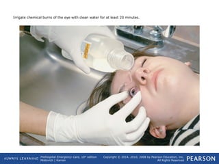 Prehospital Emergency Care, 10th
edition
Mistovich | Karren
Copyright © 2014, 2010, 2008 by Pearson Education, Inc.
All Rights Reserved
Irrigate chemical burns of the eye with clean water for at least 20 minutes.
 